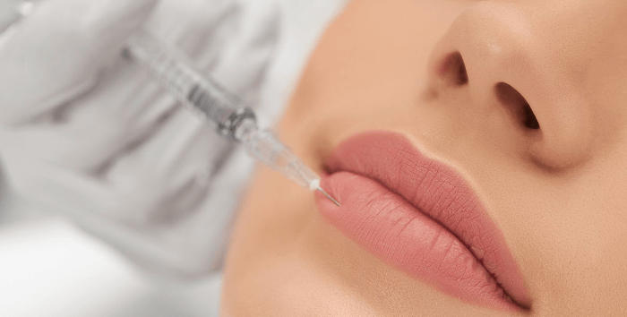 Lip filler treatment
