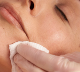 Chemical peel